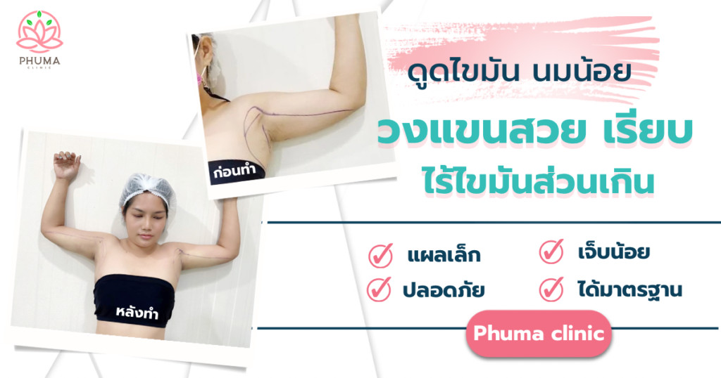 ดูดไขมันนมน้อย หมอลดา (คุณหมอหนูใหม่) phuma clinic