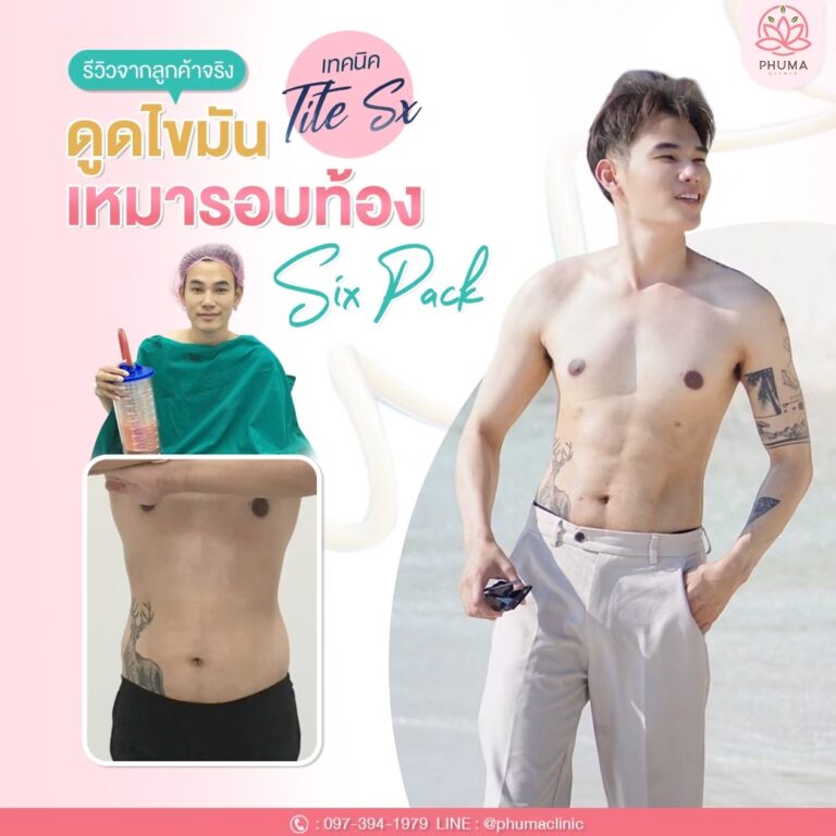 Phuma clinic (ภูม่า) พญ.ชลดา วิรัตกพันธ์ (ดูดไขมัน)